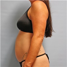 Tummy Tuck Before Photo by Jason Hess, MD; San Diego, CA - Case 47937