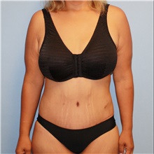 Tummy Tuck After Photo by Jason Hess, MD; San Diego, CA - Case 47939