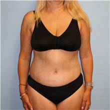 Tummy Tuck After Photo by Jason Hess, MD; San Diego, CA - Case 47940