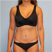 Tummy Tuck After Photo by Jason Hess, MD; San Diego, CA - Case 47941