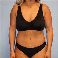 Tummy Tuck After Photo by Jason Hess, MD; San Diego, CA - Case 47954