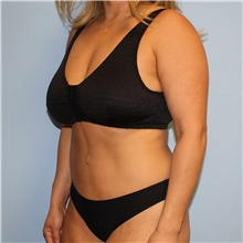 Tummy Tuck After Photo by Jason Hess, MD; San Diego, CA - Case 47954
