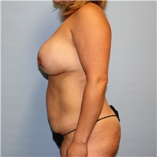 Tummy Tuck Before Photo by Jason Hess, MD; San Diego, CA - Case 47954