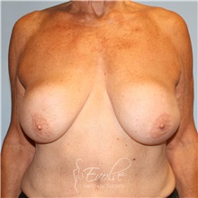 Breast Implant Revision Before Photo by Jason Hess, MD; San Diego, CA - Case 48114