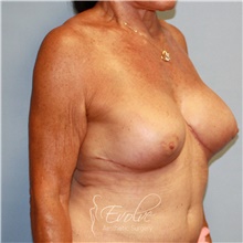 Breast Implant Revision After Photo by Jason Hess, MD; San Diego, CA - Case 48114