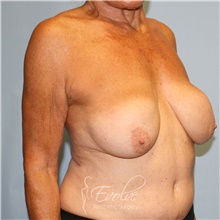 Breast Implant Revision Before Photo by Jason Hess, MD; San Diego, CA - Case 48114