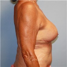 Breast Implant Revision After Photo by Jason Hess, MD; San Diego, CA - Case 48114