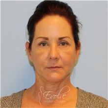 Eyelid Surgery After Photo by Jason Hess, MD; San Diego, CA - Case 48118