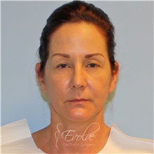 Eyelid Surgery Before Photo by Jason Hess, MD; San Diego, CA - Case 48118