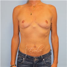 Breast Implant Removal After Photo by Jason Hess, MD; San Diego, CA - Case 48138
