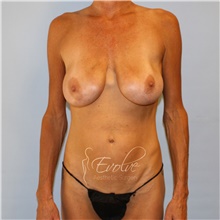 Breast Implant Removal Before Photo by Jason Hess, MD; San Diego, CA - Case 48138