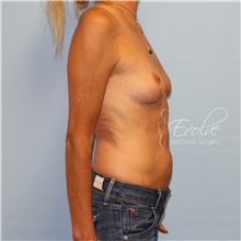 Breast Implant Removal After Photo by Jason Hess, MD; San Diego, CA - Case 48138