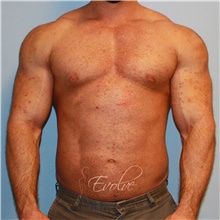 Male Breast Reduction After Photo by Jason Hess, MD; San Diego, CA - Case 48140