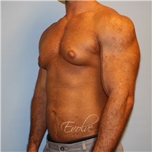 Male Breast Reduction Before Photo by Jason Hess, MD; San Diego, CA - Case 48140
