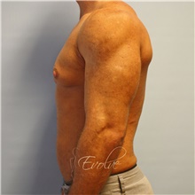Male Breast Reduction Before Photo by Jason Hess, MD; San Diego, CA - Case 48140