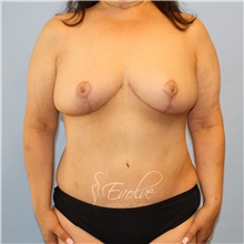 Breast Implant Removal After Photo by Jason Hess, MD; San Diego, CA - Case 48141