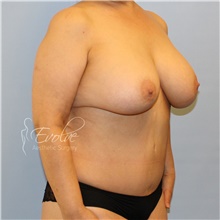 Breast Implant Removal Before Photo by Jason Hess, MD; San Diego, CA - Case 48141