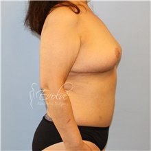 Breast Implant Removal After Photo by Jason Hess, MD; San Diego, CA - Case 48141