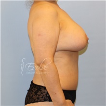 Breast Implant Removal Before Photo by Jason Hess, MD; San Diego, CA - Case 48141