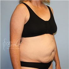 Tummy Tuck Before Photo by Jason Hess, MD; San Diego, CA - Case 48209