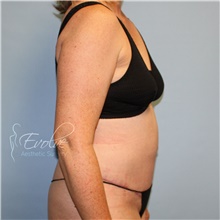 Tummy Tuck After Photo by Jason Hess, MD; San Diego, CA - Case 48209