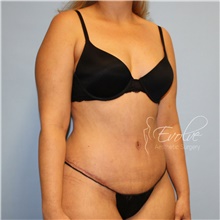 Tummy Tuck After Photo by Jason Hess, MD; San Diego, CA - Case 48279