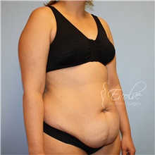 Tummy Tuck Before Photo by Jason Hess, MD; San Diego, CA - Case 48279