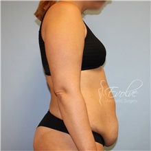 Tummy Tuck Before Photo by Jason Hess, MD; San Diego, CA - Case 48279