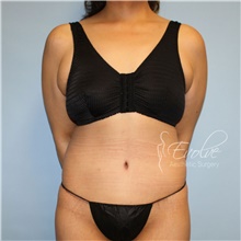 Tummy Tuck After Photo by Jason Hess, MD; San Diego, CA - Case 48280