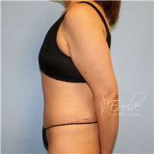 Tummy Tuck After Photo by Jason Hess, MD; San Diego, CA - Case 48280