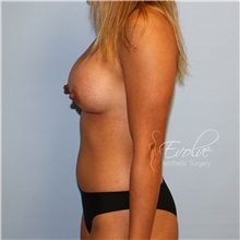 Breast Augmentation After Photo by Jason Hess, MD; San Diego, CA - Case 48281