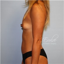 Breast Augmentation Before Photo by Jason Hess, MD; San Diego, CA - Case 48281