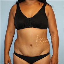 Tummy Tuck After Photo by Jason Hess, MD; San Diego, CA - Case 48305