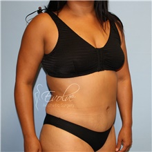 Tummy Tuck After Photo by Jason Hess, MD; San Diego, CA - Case 48305