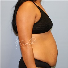 Tummy Tuck Before Photo by Jason Hess, MD; San Diego, CA - Case 48305