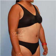 Tummy Tuck After Photo by Jason Hess, MD; San Diego, CA - Case 48306