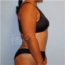 Tummy Tuck After Photo by Jason Hess, MD; San Diego, CA - Case 48306