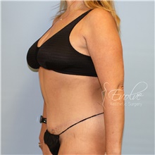 Tummy Tuck After Photo by Jason Hess, MD; San Diego, CA - Case 48307