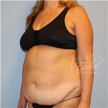 Tummy Tuck Before Photo by Jason Hess, MD; San Diego, CA - Case 48307