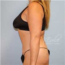Tummy Tuck After Photo by Jason Hess, MD; San Diego, CA - Case 48307