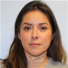 Eyelid Surgery After Photo by Jason Hess, MD; San Diego, CA - Case 48372
