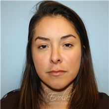 Eyelid Surgery Before Photo by Jason Hess, MD; San Diego, CA - Case 48372