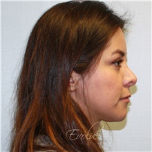 Eyelid Surgery After Photo by Jason Hess, MD; San Diego, CA - Case 48372