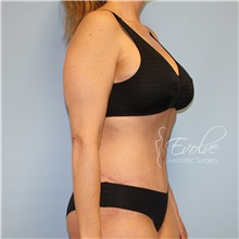 Tummy Tuck After Photo by Jason Hess, MD; San Diego, CA - Case 48430
