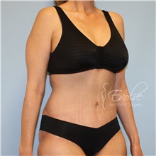 Tummy Tuck After Photo by Jason Hess, MD; San Diego, CA - Case 48430