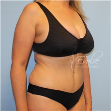 Tummy Tuck After Photo by Jason Hess, MD; San Diego, CA - Case 48442