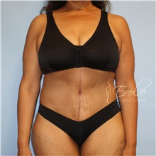 Tummy Tuck After Photo by Jason Hess, MD; San Diego, CA - Case 48470