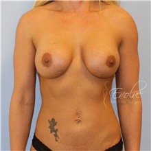 Breast Augmentation After Photo by Jason Hess, MD; San Diego, CA - Case 48497