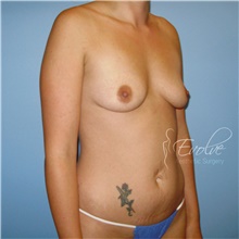 Breast Augmentation Before Photo by Jason Hess, MD; San Diego, CA - Case 48497