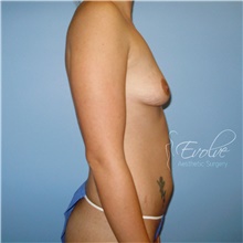 Breast Augmentation Before Photo by Jason Hess, MD; San Diego, CA - Case 48497
